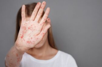 The Ongoing Measles Outbreak Has Reached a New Peak